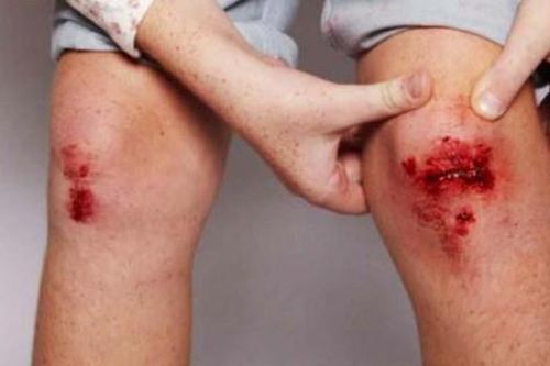 Làm thế nào để xác định xem con bạn có nguy cơ mắc bệnh máu khó đông hay không?
