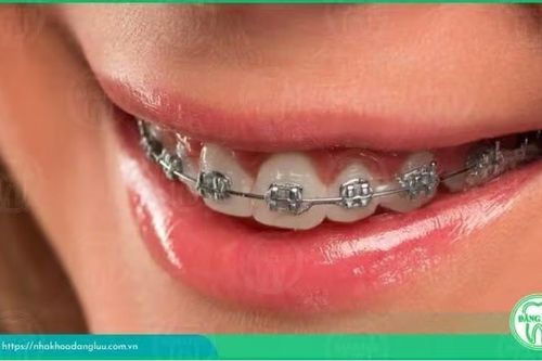 Niềng răng có đau không? Cách giảm đau hiệu quả sau khi niềng răng?