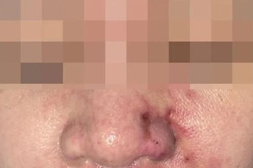 Nhập viện vì biến chứng sau khi tiêm filler tại spa của 'người quen'
