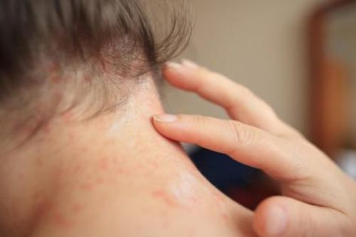 Biện pháp tại nhà phòng và trị rôm sảy