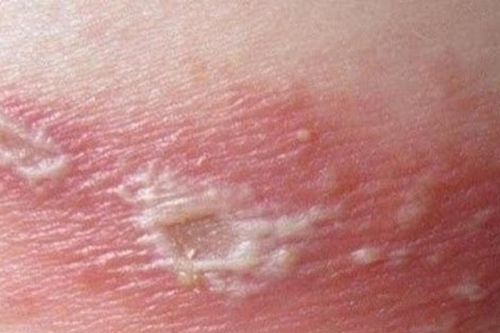 Biến chứng nguy hiểm của bệnh zona thần kinh