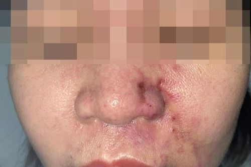 Thêm 1 phụ nữ nhập viện sau tiêm filler chỗ 'người quen'
