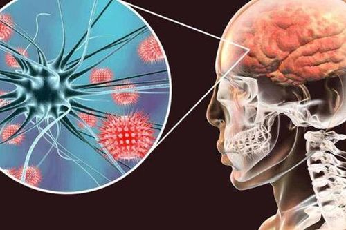 Đau đầu âm ỉ, người đàn ông 42 tuổi bất ngờ phát hiện viêm màng não vì ăn thịt lợn theo cách này