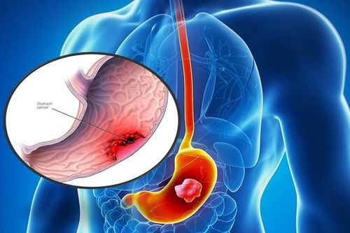 Những thói quen gây hại dạ dày
