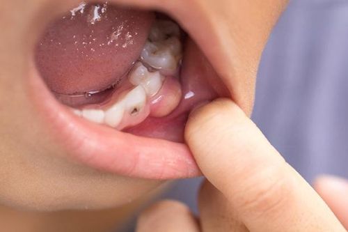 Những thói quen gây viêm lợi ít người biết