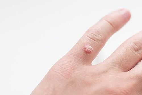 Kết hợp thuốc uống và bôi trị mụn cơm