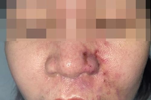 Nhập viện sau khi tiêm filler tại spa của người quen