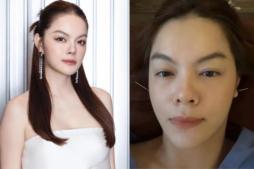Phạm Quỳnh Anh gặp sự cố sức khỏe, phải dùng kim châm để điều trị