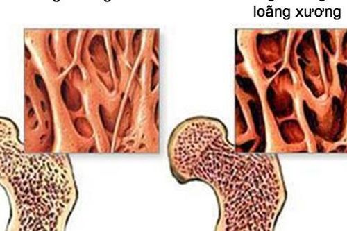 Xoa bóp bấm huyệt có lợi ích gì với người loãng xương?