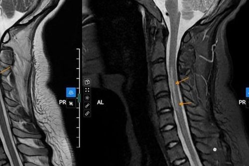 Nữ sinh đột ngột liệt tay phải sau khi ngủ dậy