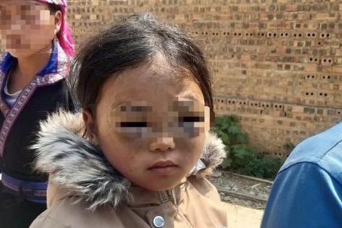 Công an vào cuộc điều tra vụ bé gái lớp 1 nghi bị cô giáo đánh tím mắt