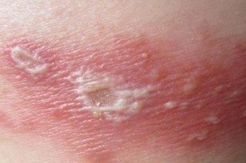 Biến chứng nguy hiểm do zona thần kinh