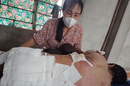 MS 922: Xin cứu giúp người đàn ông đang nguy kịch sau tai nạn bỏng