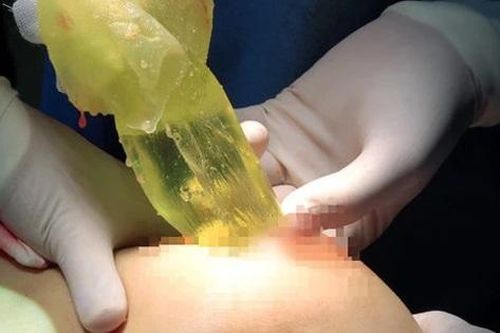 2 phụ nữ bị vỡ túi ngực mà không biết, chuyên gia cảnh báo biến chứng khó lường, chị em nâng ngực có dấu hiệu này cần khám ngay