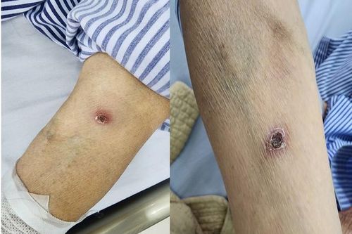 Cụ bà nguy kịch sau cơn sốt cao, rét run, nguyên nhân chỉ từ một vết đốt