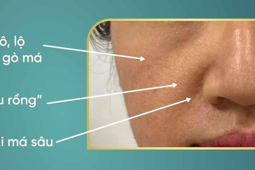 Rãnh mũi má và 'râu rồng' ở tuổi trung niên: Phương pháp thẩm mỹ nào an toàn và hiệu quả?