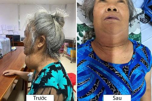 Phẫu thuật thành công bệnh nhân có bướu tuyến giáp khổng lồ