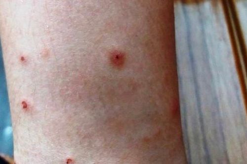 Nhiều người trong một gia đình bị côn trùng đốt