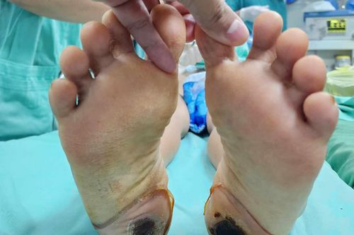 Suýt liệt vĩnh viễn do sử dụng phương pháp dân gian trị đau cột sống
