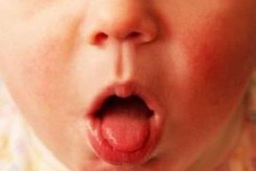 Ca mắc ho gà tăng 8 lần và những biến chứng nguy hiểm cần biết
