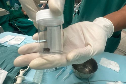 Bé trai 8 tháng tuổi nhập viện sau khi chơi với quả xoài