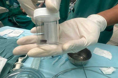 Cứu sống bé trai 8 tháng tuổi bị hóc cuống xoài vào đường thở