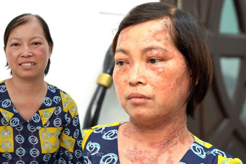 Hành trình 'thay da' cho người phụ nữ 10 năm bị bong vảy khắp cơ thể