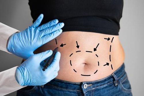 Những ai không nên hút mỡ bụng?