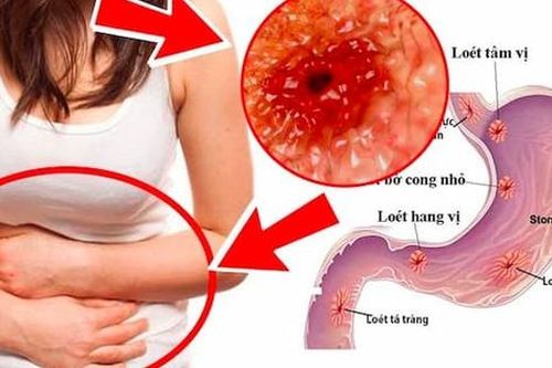 Mùa lễ hội cẩn thận với viêm dạ dày cấp