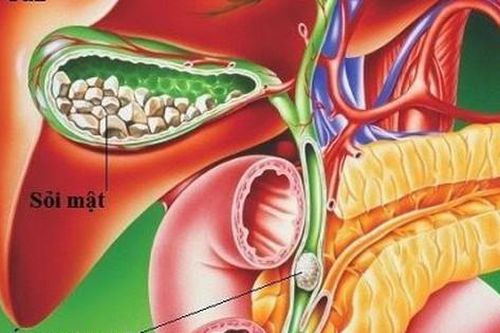 Sỏi túi mật có phải phẫu thuật không?