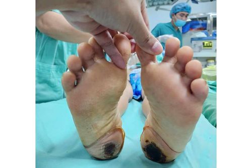 Suýt bị liệt do dùng phương pháp dân gian chữa đau cột sống