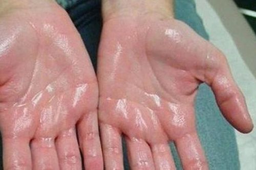 Trời nóng dễ đổ mồ hôi nhưng bác sĩ nhắc nhở 7 kiểu này là bệnh, gồm cả ung thư