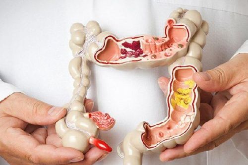 Tầm soát ung thư tiêu hóa khi chưa có triệu chứng