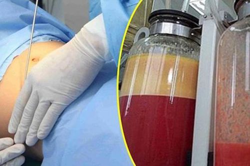 Lợi và hại của các phương pháp hút mỡ