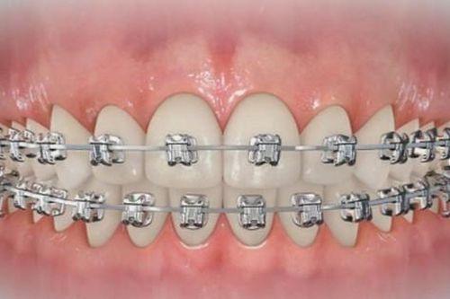 Niềng răng có gây hại gì không?