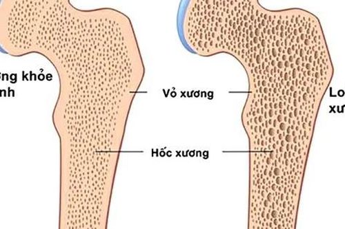 Người bị loãng xương tập gì, kiêng tập gì?