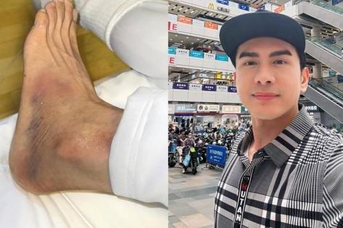Nam ca sĩ Việt gặp vận xui ở trời Tây: Bị ngã trẹo chân, thất lạc vali nên gần 1 tuần không dám gội đầu