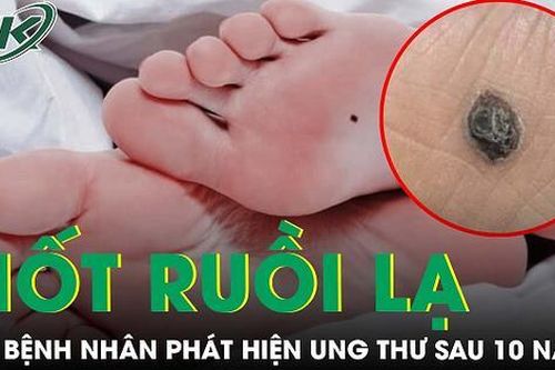Phát hiện ung thư từ nốt ruồi dưới lòng bàn chân