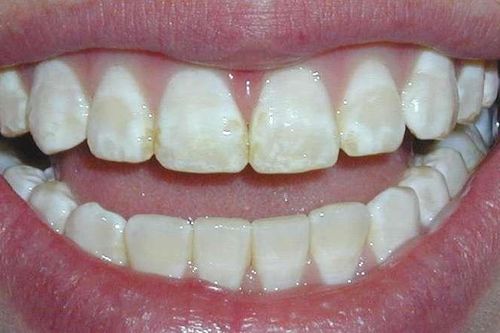 6 bệnh về răng miệng nguy hiểm cần phát hiện sớm