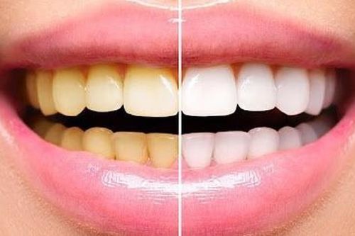 Tẩy trắng răng có hại không? Các bước tẩy trắng răng tại nhà