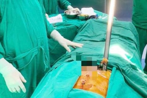 Người đàn ông bị xà beng đâm xuyên thành bụng