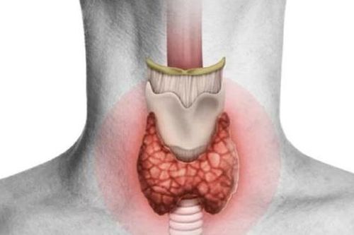 Cách điều trị và biện pháp phòng ngừa bệnh bướu giáp lan tỏa