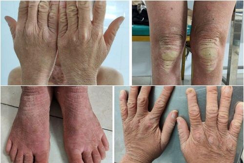 Sinh ra bị màng bọc quanh cơ thể, lớn lên phát hiện mắc bệnh di truyền hiếm gặp