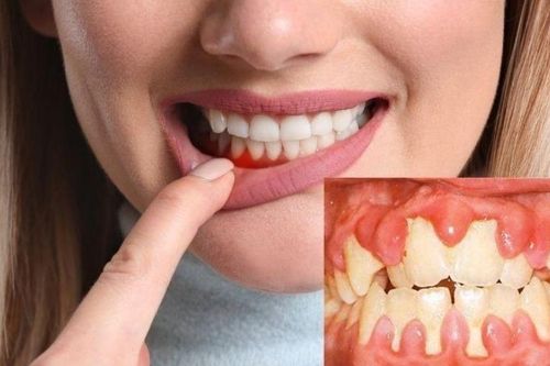 5 cách điều trị viêm nướu tại nhà