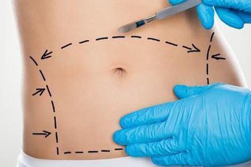 Được và mất khi phẫu thuật tạo hình thành bụng