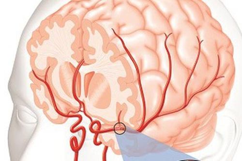 Trẻ 10 tuổi bị xuất huyết não, làm gì để phát hiện sớm căn bệnh này?
