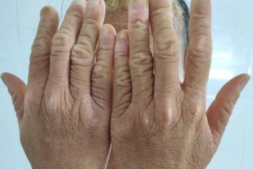 Căn bệnh khiến cô gái sinh ra với lớp vảy sừng toàn thân