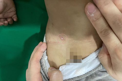 Vết đốt gây nguy hiểm cho bé 15 tháng tuổi