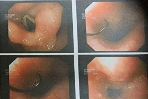 Gắp lưỡi câu cá từ miệng bệnh nhi 13 tuổi