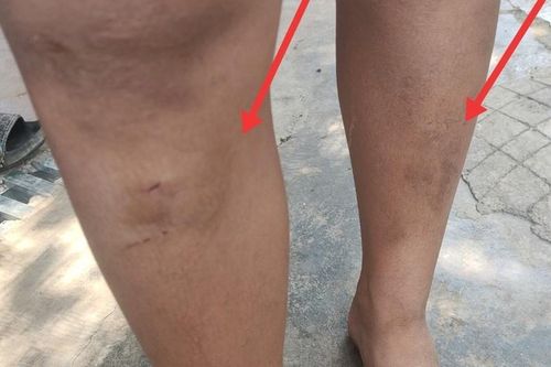 Chuyển hồ sơ xử lý vụ 5 cháu nhỏ bị hàng xóm đánh